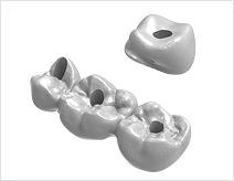 Screw-Retained Bridge
