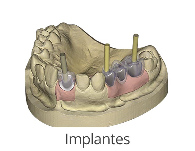 modulos exocad implantes